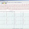 NorthEast Monitoring Holter LX Analysis Software